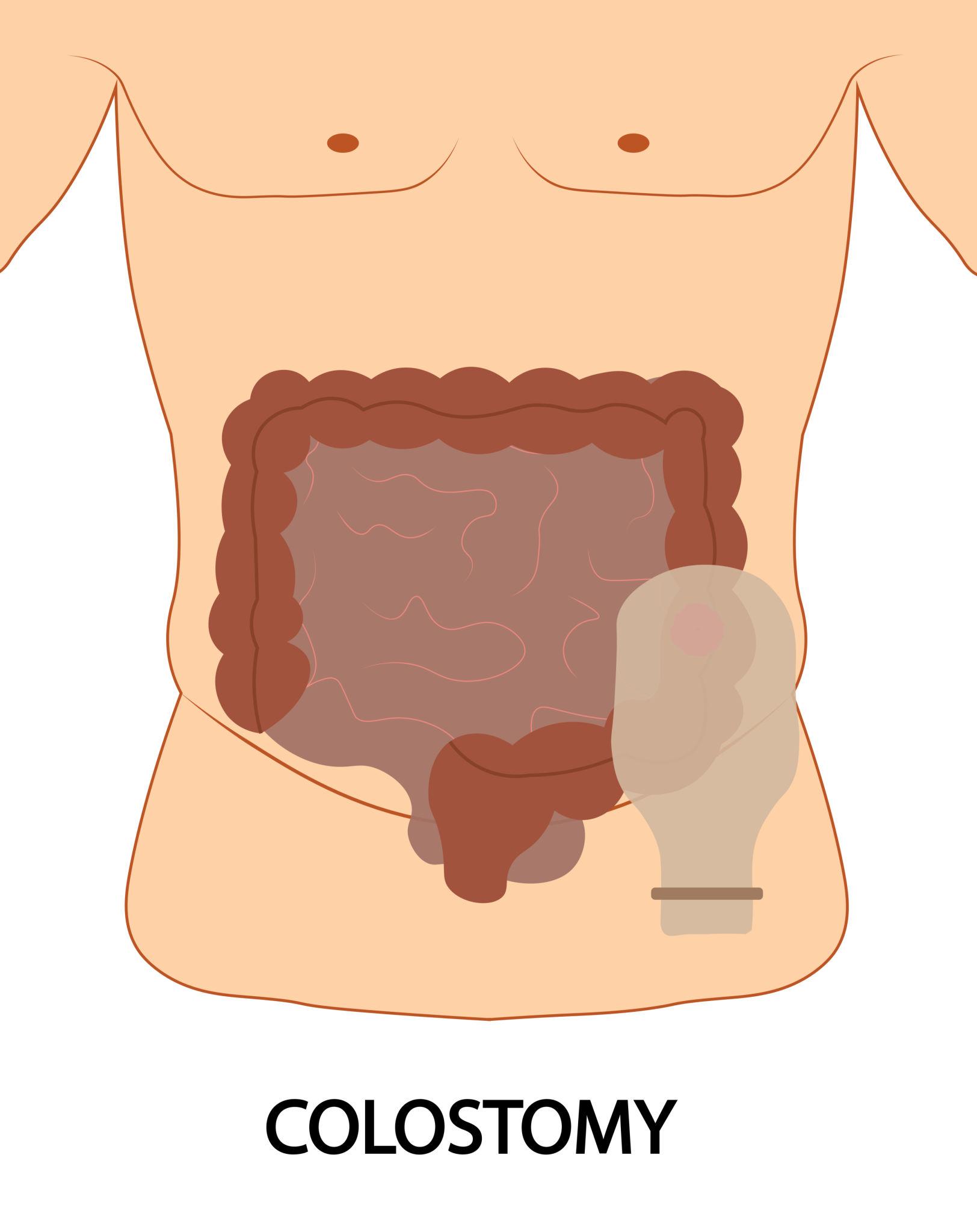 Colostomy - Ostomy