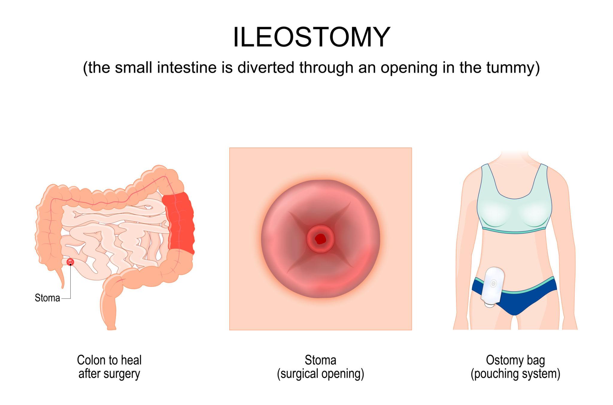 Ileostomy - Ostomy