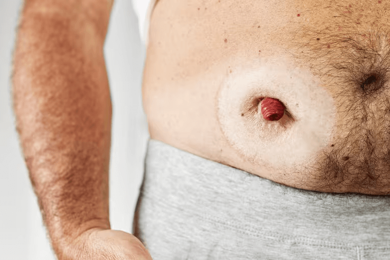 Stoma Ostomy