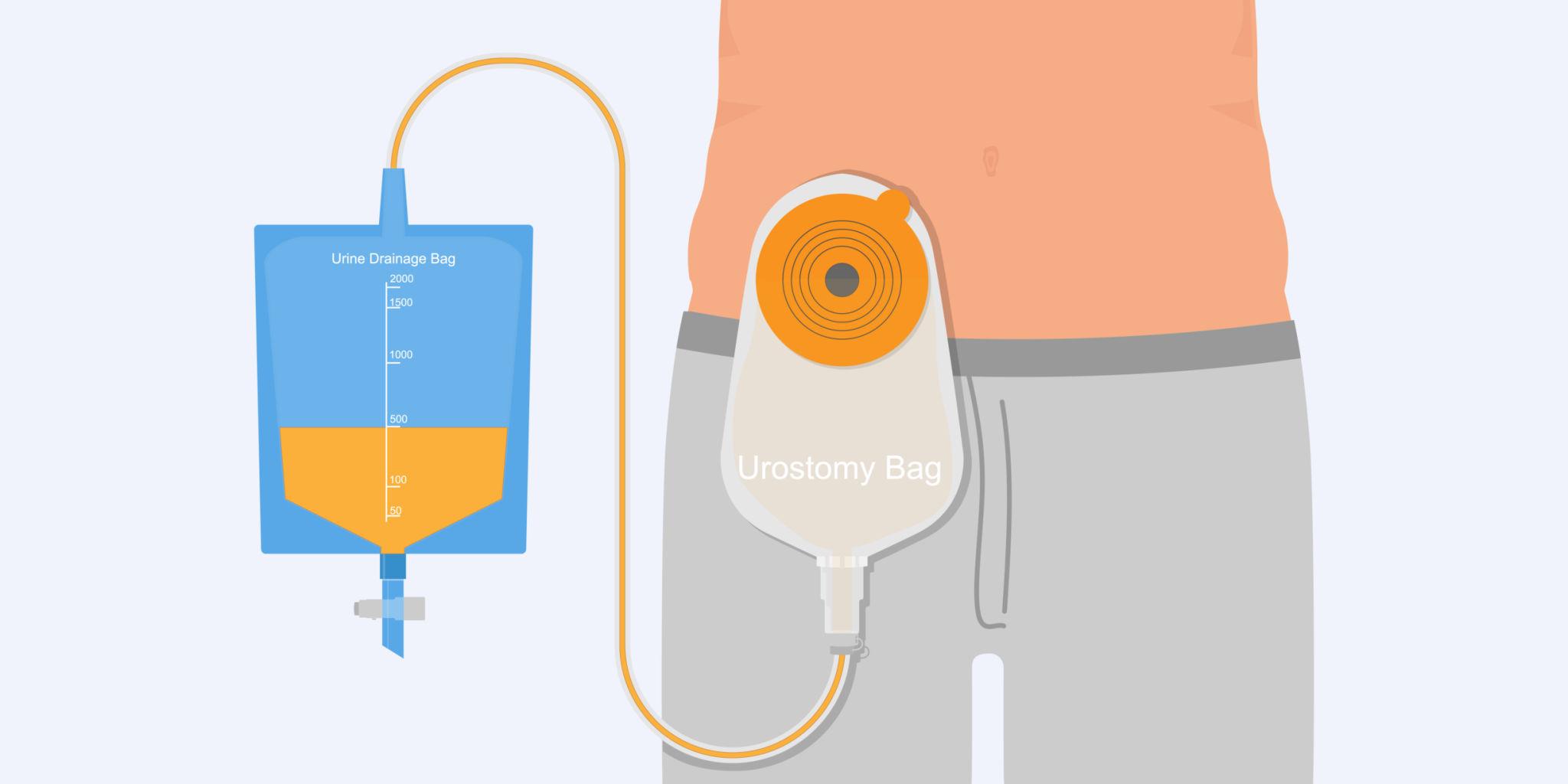Urostomy - Ostomy